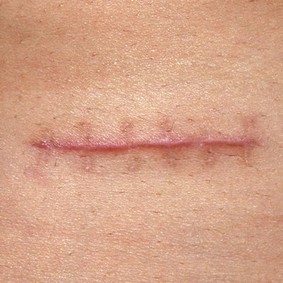 Surgical scars