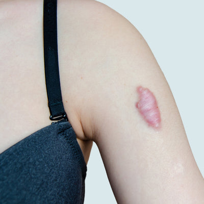 Keloid scars