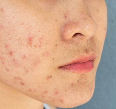 Acne scars