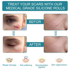 Silicone Scar Remover Tape for Acne & Wrinkles