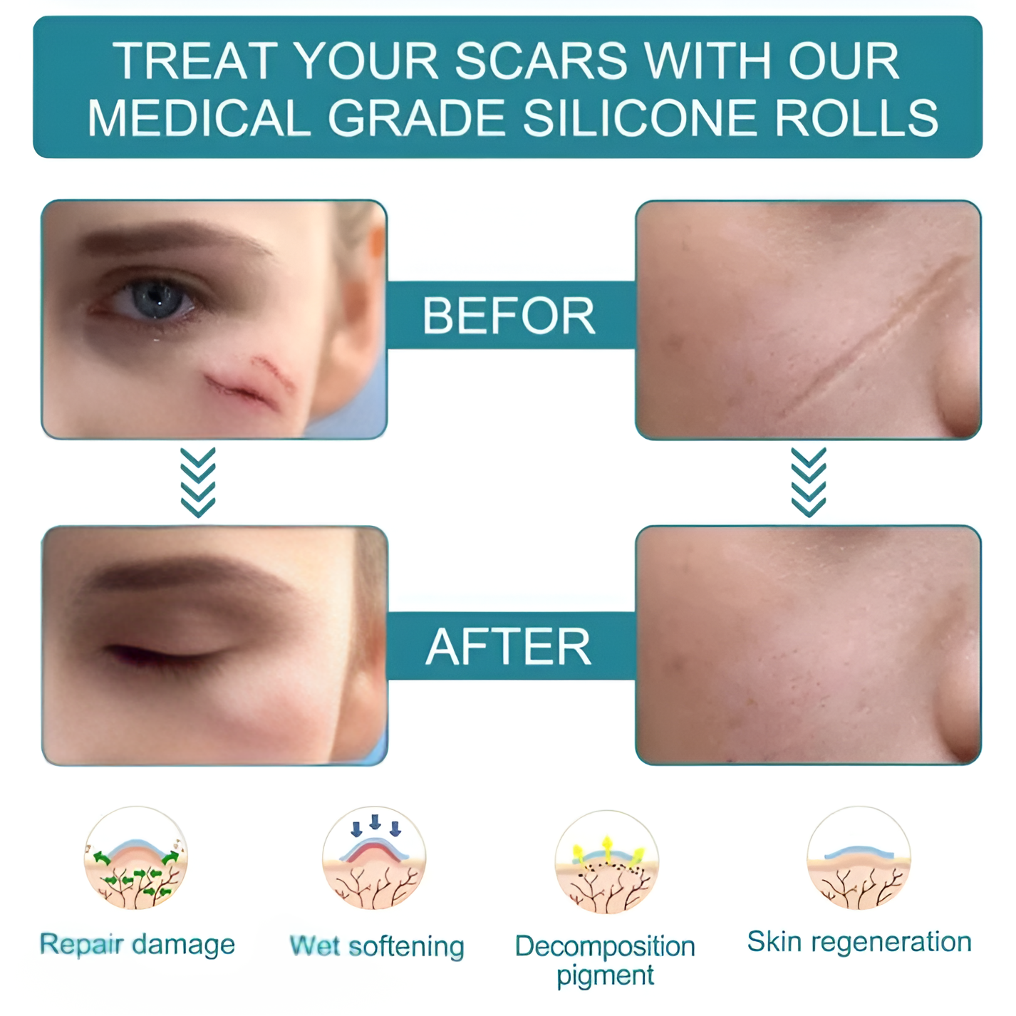 Silicone Scar Remover Tape for Acne & Wrinkles