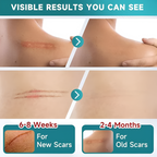Silicone Scar Remover Tape for Acne & Wrinkles