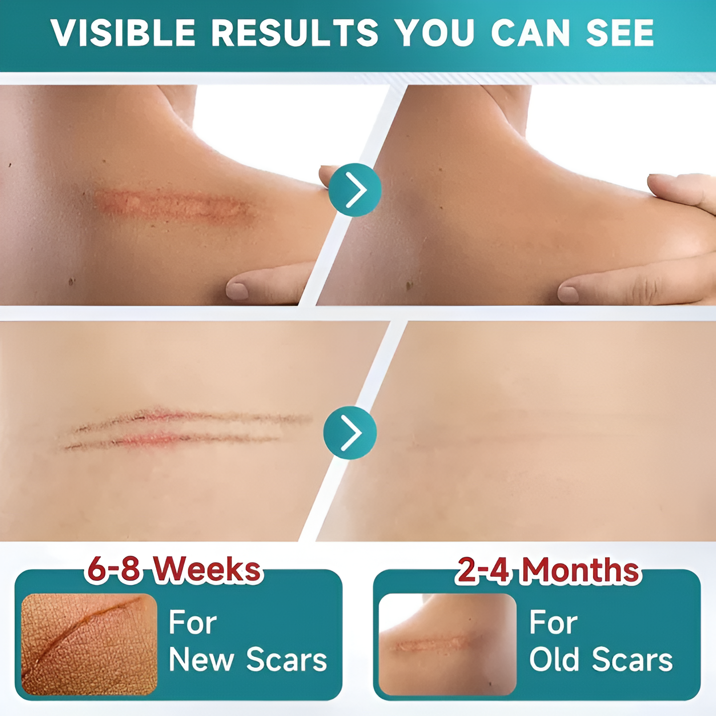 Silicone Scar Remover Tape for Acne & Wrinkles