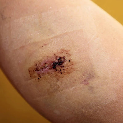 Injury scars