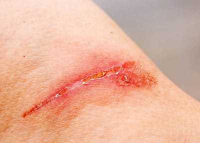 Burn scars