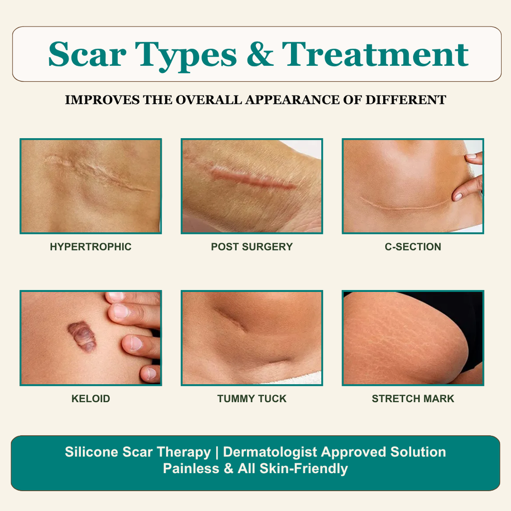 Silicone Scar Remover Tape for Acne & Wrinkles